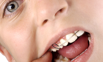 Τί να κάνω αν κάποιο ορθοδοντικό σύρμα ή σιδεράκι πληγώνει εσωτερικά το στόμα του παιδιού;
